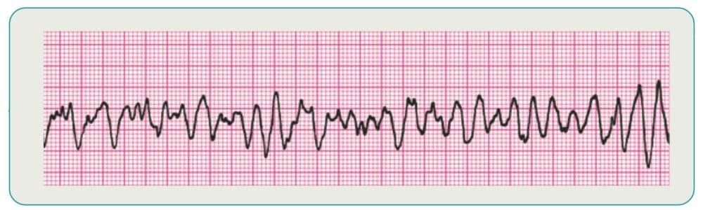 Ventricular fibrillation — chaotic, with no identifiable P wave, QRS, or T wave.