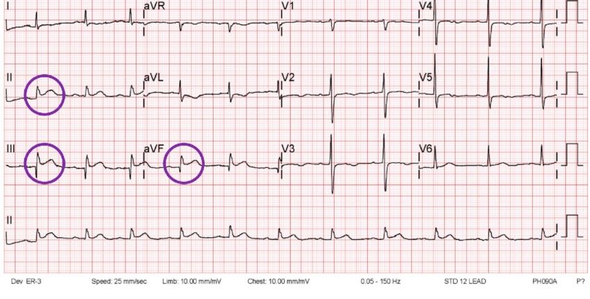 ST elevation circled in leads II, III, and aVF — the inferior leads. Two contiguous inferior leads with elevation confirms an inferior STEMI, and points at the right coronary artery.