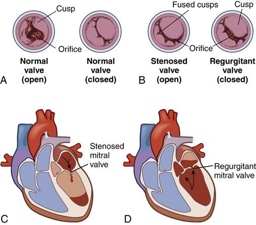 Valvular stenosis and regurgitation. (A) Normal valve open and closed. (B) A stenosed valve cannot open fully; a regurgitant valve cannot close fully. (C) Mitral stenosis limits left ventricular filling. (D) Mitral regurgitation lets blood re-enter the left atrium during systole.