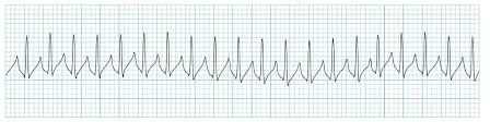 Practice: what is the first treatment for this rhythm if the patient is hemodynamically stable?