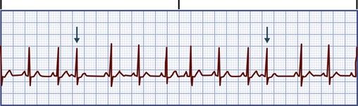 Premature atrial contractions, arrowed. The early beat breaks the R-to-R regularity.