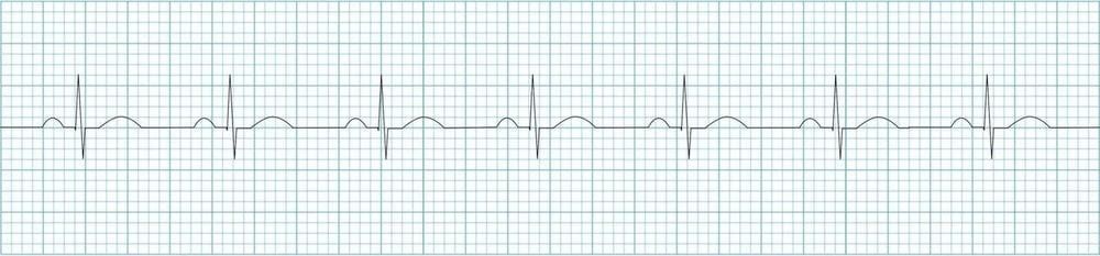 Practice: what is the rate in this six-second strip? Count the QRS complexes and multiply by 10.