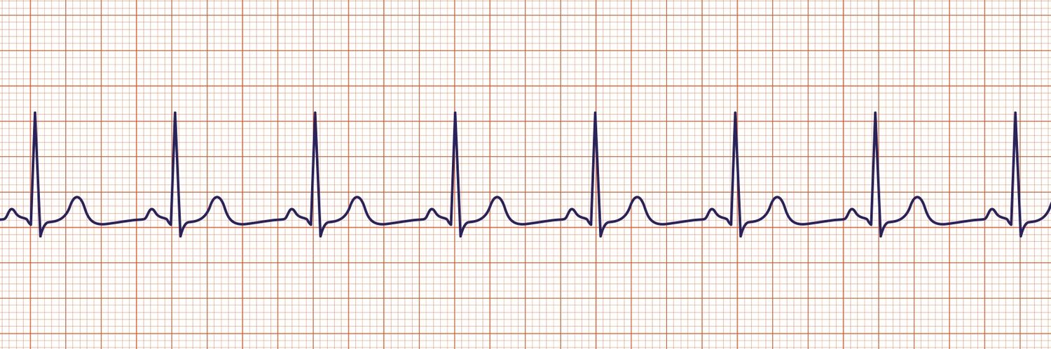 You find your patient pulseless and this is the rhythm on the monitor. An organized rhythm with no pulse is PEA — start CPR. This is the strip that proves why you assess the patient, not the screen.