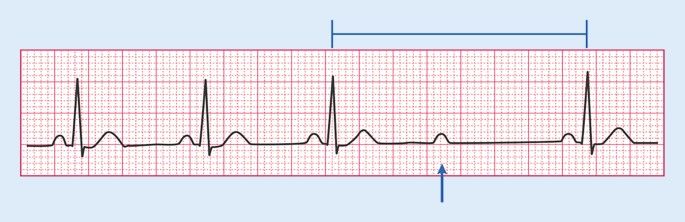 Mobitz II. A P wave arrives with no QRS following it, and the PR interval on the conducted beats never varies.