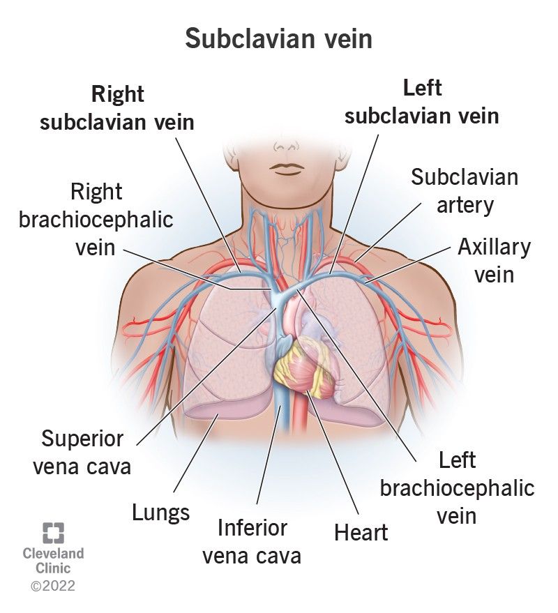 The subclavian vein — the route the ICD lead system takes to reach the endocardium.