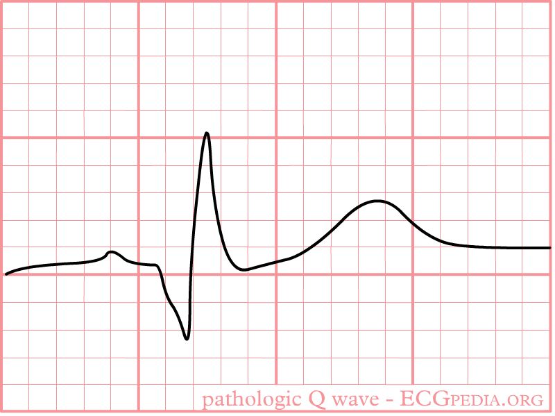 A pathologic Q wave — deeper and wider than a normal Q, and evidence of a prior myocardial infarction.