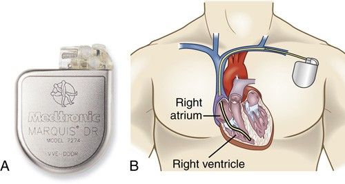 An ICD. The pulse generator sits over the pectoral muscle on the patient's non-dominant side, with leads to the right atrium and right ventricle.