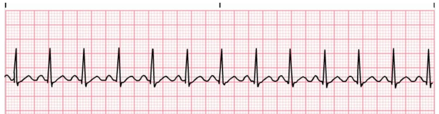 Sinus tachycardia. Thirteen complexes in six seconds gives a rate of 130.