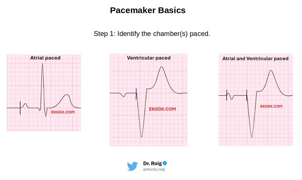 Pacer spikes tell you what is being paced. Atrial pacing: spike before the P wave. Ventricular pacing: spike before the QRS. AV pacing: a spike before each.