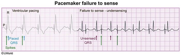 Failure to sense: the pacemaker fires without regard for the patient's own complexes, producing unsensed QRS complexes at the wrong moments.