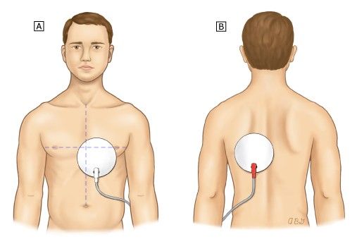 Transcutaneous pacer pad placement — anterior at V4, posterior between the spine and left scapula at the level of the heart.