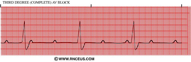 Third-degree AV block. P waves and QRS complexes march independently — atrioventricular dissociation.