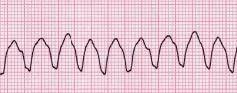 Ventricular tachycardia — a run of wide, distorted complexes with no visible P waves.