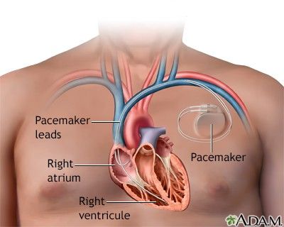 Permanent pacemaker with leads to the right atrium and right ventricle.