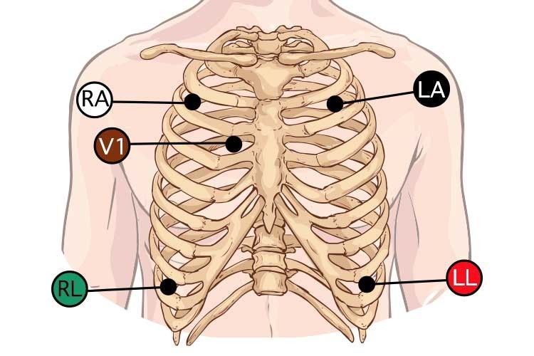 Five-lead placement: RA and LA at the shoulders, RL and LL at the lower torso, V1 at the fourth intercostal space right sternal border.