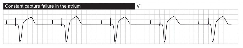 Failure to capture in the atrium: pacer spikes fire but no P wave follows.