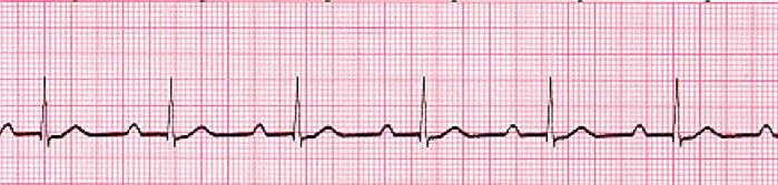First-degree AV block. Every P wave conducts, but the PR interval is prolonged beyond 0.20 second.