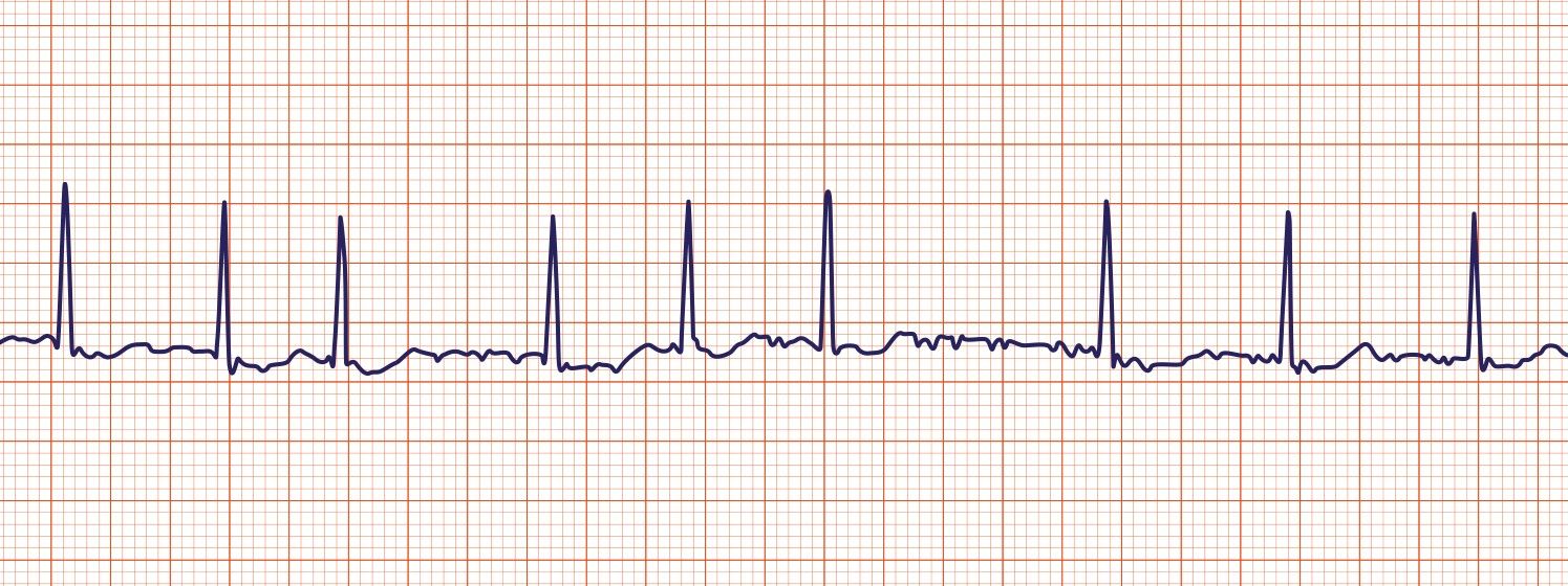 Atrial fibrillation. No discernible P waves and an irregularly irregular ventricular response.