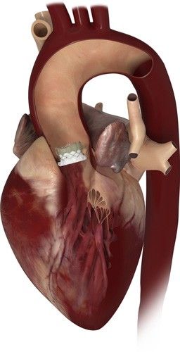 A transcatheter aortic valve seated in the aortic position.
