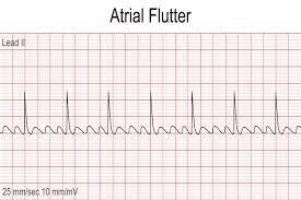 Atrial flutter. The sawtooth baseline between QRS complexes is the flutter wave — the most recognizable pattern on the exam.