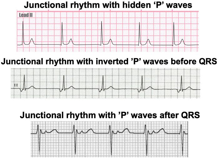 The three faces of a junctional rhythm: hidden P waves, inverted P waves before the QRS, and P waves appearing after the QRS.