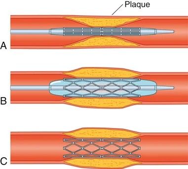 Stent placement. (A) Guidewire crosses the plaque. (B) Balloon inflates, expanding the stent against the plaque. (C) Balloon is withdrawn; the stent holds the lumen open.