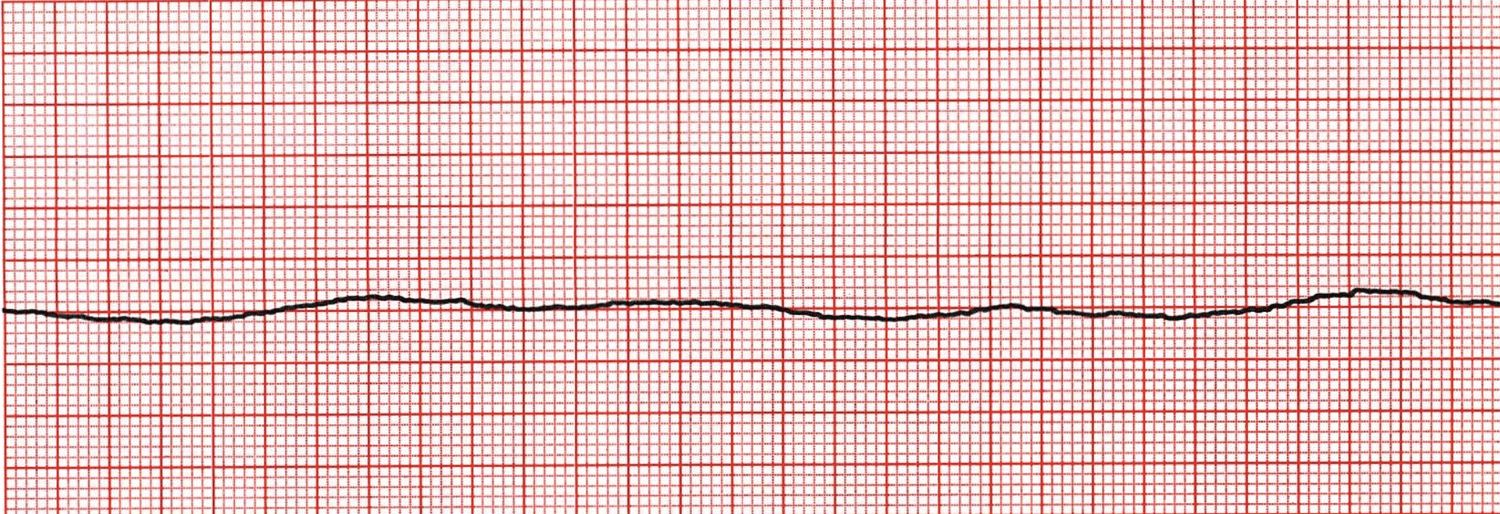 Asystole.