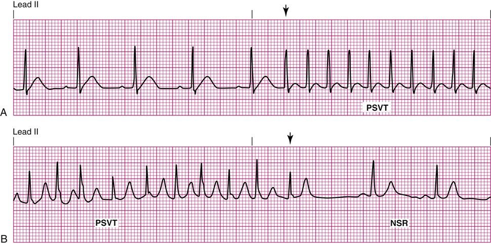PSVT. In A the rhythm accelerates abruptly into PSVT; in B PSVT converts back to normal sinus rhythm.