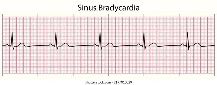 Sinus bradycardia. Counting five QRS complexes in a six-second strip gives a rate of 50.