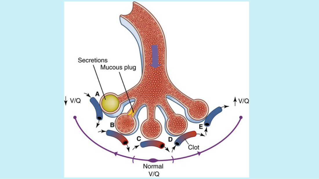 Her V/Q mismatch slide, four panels. Left: alveolus filled with secretions — a ventilation problem with intact perfusion. Next: a smaller mucus plug, the same problem less severely. Then a normal V/Q unit for comparison. Right: a clot in the capillary — a perfusion problem with intact ventilation.